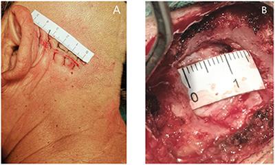 Microvascular decompression: Diversified of imaging uses, advantages of treating trigeminal neuralgia and improvement after the application of endoscopic technology